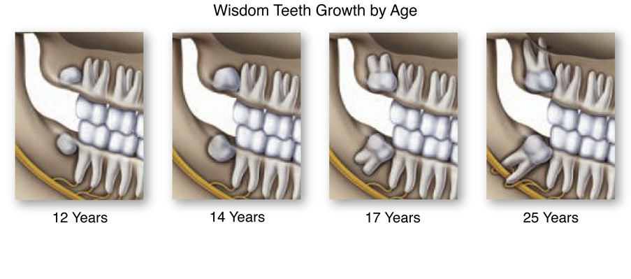 wisdom teeth removal Alexandria